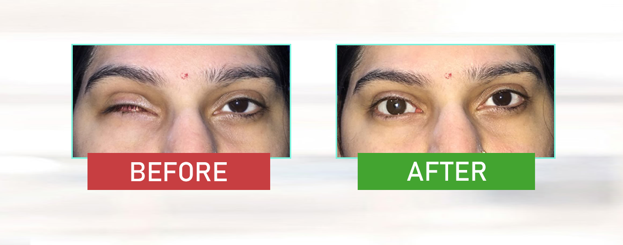artificial eye before-after